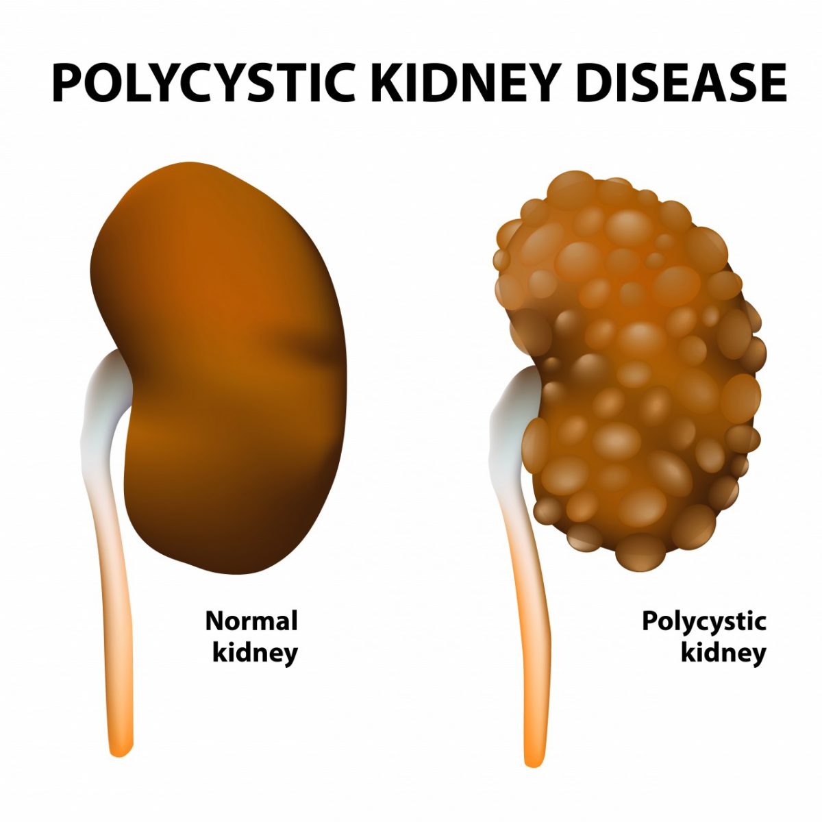 NICE Recommends Otsuka's Tolvaptan for Patients with a Chronic Kidney ...