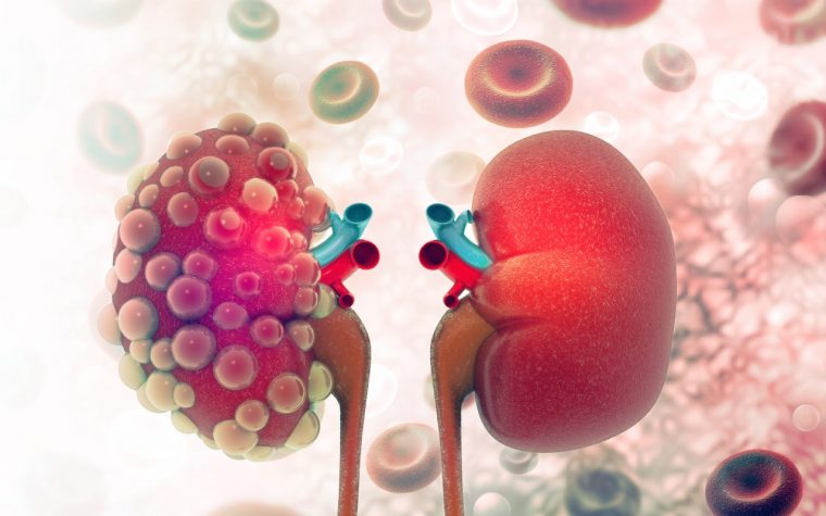 Reata to Initiate Phase 2/3 Trial of Therapy Candidate for Kidney Disease Caused by Alport Syndrome